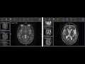 Brain Atrophy on MRI
