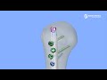 Double Medical Universal Humerus Nail