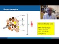 Needle EMG: normal vs myopathic MUPs