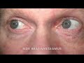 RS Supranuclear Ocular Motor Pathways Part 1 - Horizontal Saccades