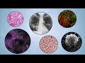 Working with Natural Born Killers: Using Natural Killer Cells to Improve Cancer Immunotherapies