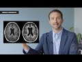 MRIs in Multiple Sclerosis Explained