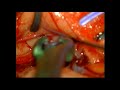 Right MCA aneurysm clipping unruptured