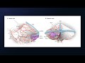 Torcular Craniotomy for Resection of a Cerebellar Arteriovenous Malformation