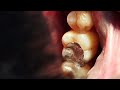 how does a amalgam filling looks...