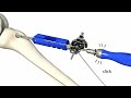 Mathys: Ligamys surgical technique, Animation