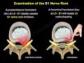 Examination Of S1 Nerve Root - Everything You Need To Know - Dr. Nabil Ebraheim