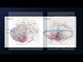 Suboccipital Craniotomy for Resection of a Tonsillar Cerebellar Arteriovenous Malformation