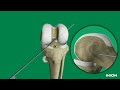 ACL Reconstruction Using the Inion Hexalon™ Screw and Inion FlipButton™