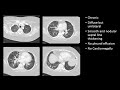 Chest Radiology - Pattern – Interstitial Screencast