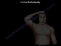 Cervical Radiculopathy - Everything You Need To Know - Dr. Nabil Ebraheim