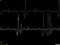 Motor unit with satellite potentials