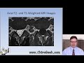 Dr. Gillard lectures on How to Read Your Lumbar MRI