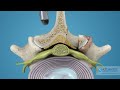 What is Endoscopic Lumbar Laminotomy? | Laminectomy