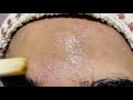 ACNE Treatment At Home | 3 day Acne REMOVAL Challenge | Acne Treatment Ayurvedic with Results