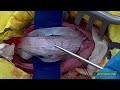 Selective Dorsal Rhizotomy (Stop Motion Animation)