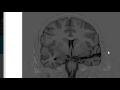 MRI in Epilepsy