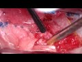 Myxopapillary ependymoma resection