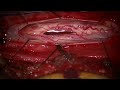 Thoracic intramedullary ependymoma resection, Ultrasound Assisted