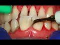 Deep Cleaning With HEAVY Tartar Build Up At The Dentist