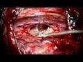 Interhemispheric Contralateral Transcallosal Approach & Resection of Caudate Basal Ganglia Cavernoma