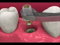 Smyl Manatee - Dental Implant Procedure