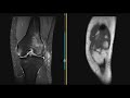 Normal ACL and ACL tear | First Look MRI