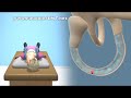 Epley Maneuver to Treat BPPV Vertigo