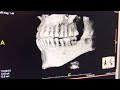 Scan of Tooth #17 (More Hollow Than the Rest)