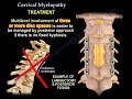 Cervical Myelopathy - Everything You Need To Know - Dr. Nabil Ebraheim