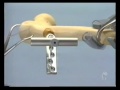 Dynamic hip screw DHS AO FOUNDATION