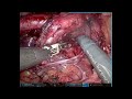 Robotic PLND and Nerve Sparing RPLND Clear Cell Carcinoma Endometrium