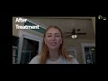 Young student shares her rapid recovery from severe anxiety and depression with accelerated TMS