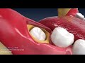 Wisdom teeth removal animation