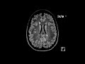 MS white matter lesions | First Look MRI