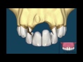 Bridge V/s Dental Implant