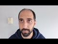 2 month Hair Transplant Update from Turkey! / Taking Finasteride