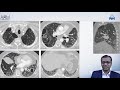 Overview of HRCT (CT CHEST) Imaging in Interstitial Lung Disease