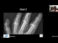 How to diagnose arthritis on X-rays?  #education #radedu #medicaleducation