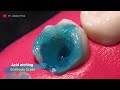 AMAZING restoration of tooth with extensive cavity: RCT in 4K