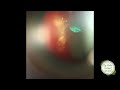 FORBIDDEN TREATMENT: Laser for Vitreous Hemorrhage