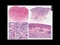 Pursue 26U : BENIGN MELANOCYTIC LESIONS OF THE SKIN