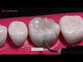 AMAZING reconstruction of tooth damaged by caries: Endodontics