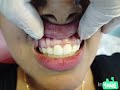 front tooth restored with all ceramic crowns