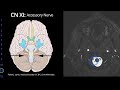 Cranial Nerve Anatomy on MRI