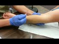 How to start an IV : Antecubital Fossa