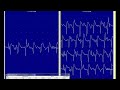 myotonic discharges