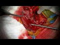 Right Carotid endarterectomy with out patch graft