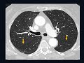 Advanced Imaging: Basic Chest CT Anatomy