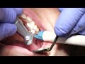 Dentist Filling A Cavity Between Teeth